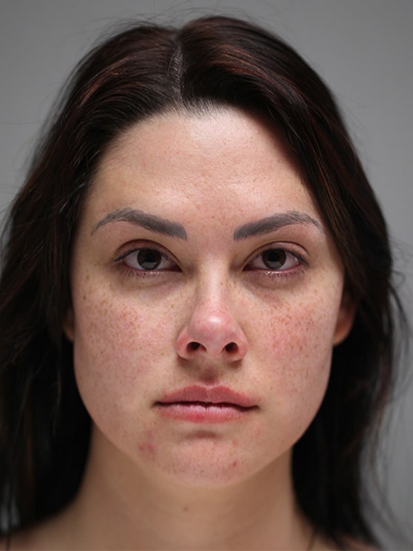 After Image: Ptosis Repair - front
