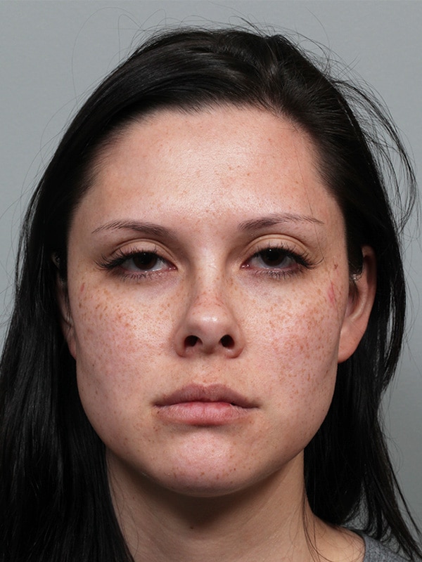 Before Image: Ptosis Repair - front