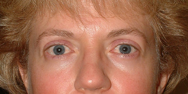 Thyroid Eye Disease (Graves’)