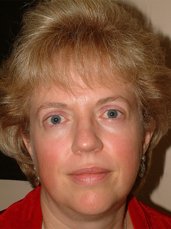 After Image: Thyroid Eye Disease (Graves’) - front
