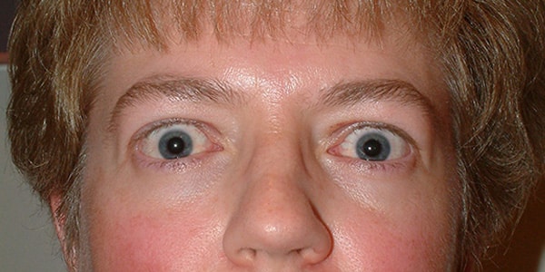 Thyroid Eye Disease (Graves’)