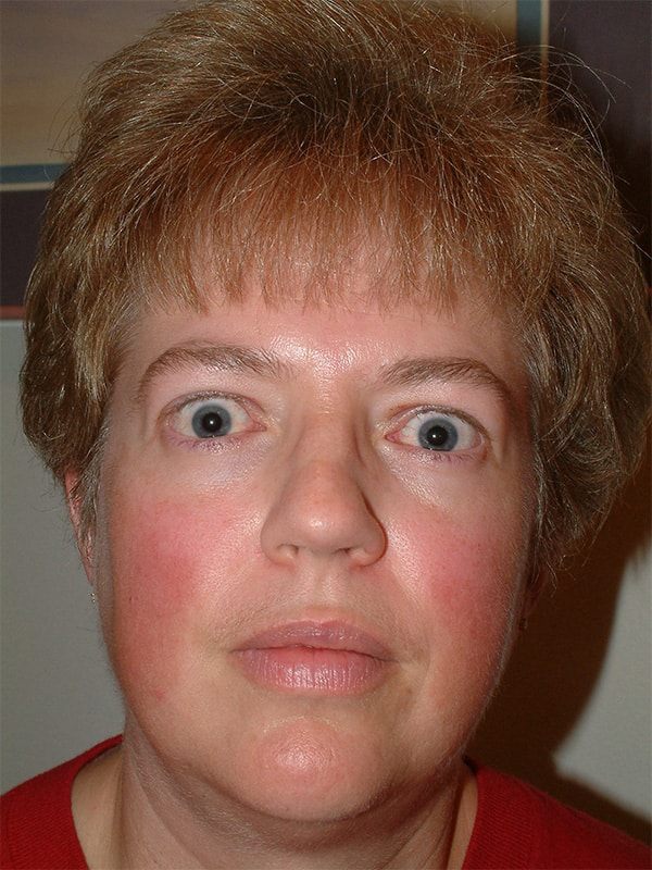 Before Image: Thyroid Eye Disease (Graves’) - front
