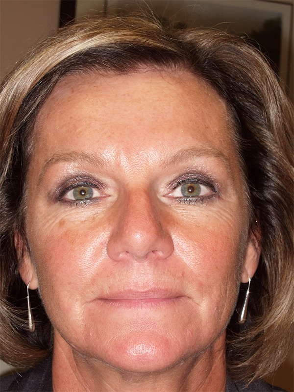 After Image: Upper & Lower Blepharoplasty - front