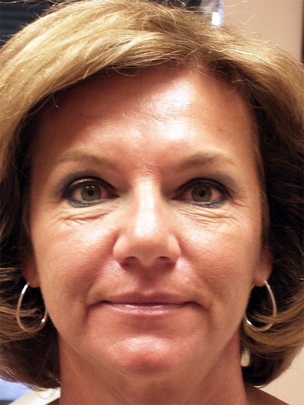 Before Image: Upper & Lower Blepharoplasty - front