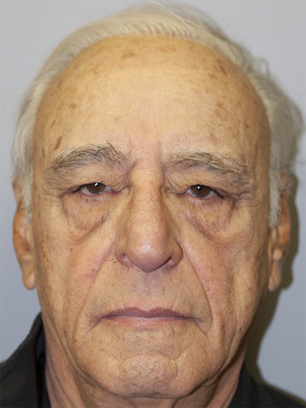 Before Image: Upper Blepharoplasty - front