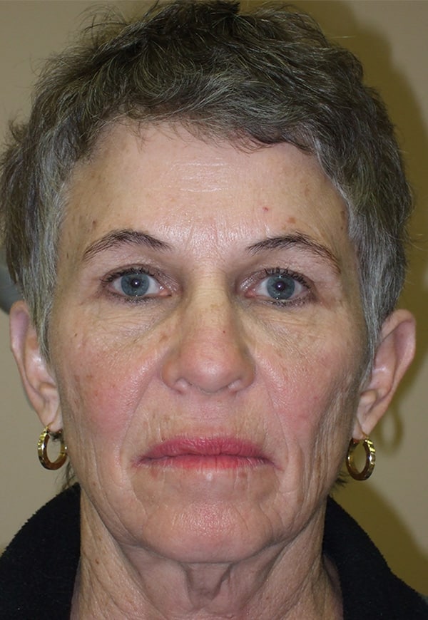 After Image: Upper Blepharoplasty and Endoscopic Browlift - front