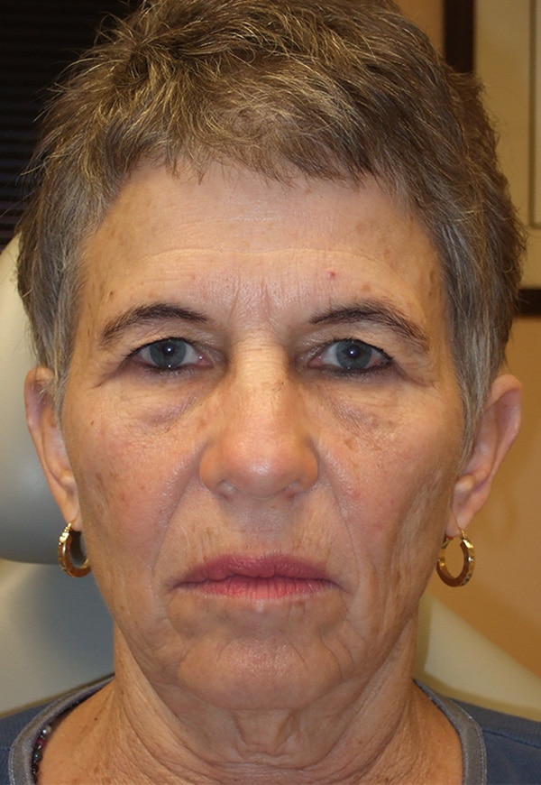 Before Image: Upper Blepharoplasty and Endoscopic Browlift - front