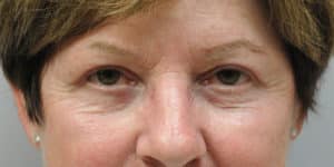 Upper & Lower Blepharoplasty