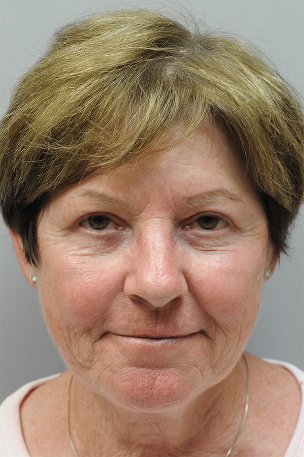 After Image: Upper & Lower Blepharoplasty - front