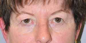 Upper & Lower Blepharoplasty