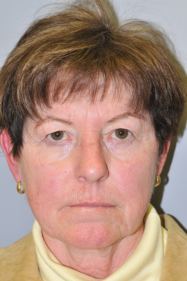 Before Image: Upper & Lower Blepharoplasty - front