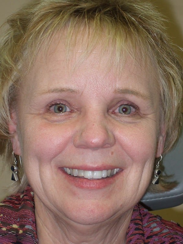 After Image: Ptosis Repair - front