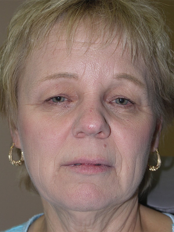 Before Image: Ptosis Repair - front
