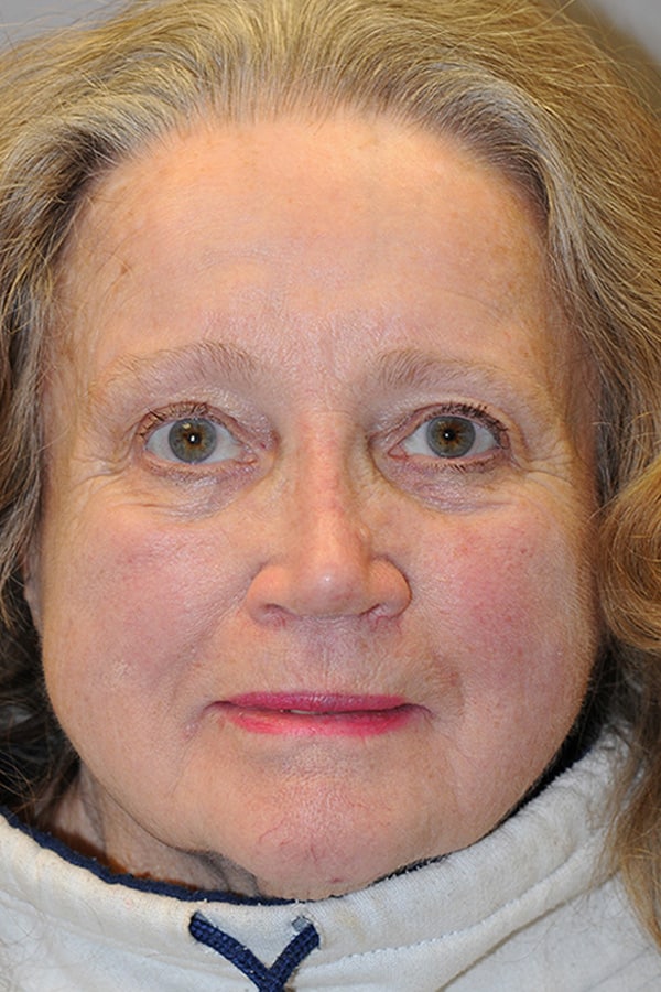 After Image: Ptosis Repair - front
