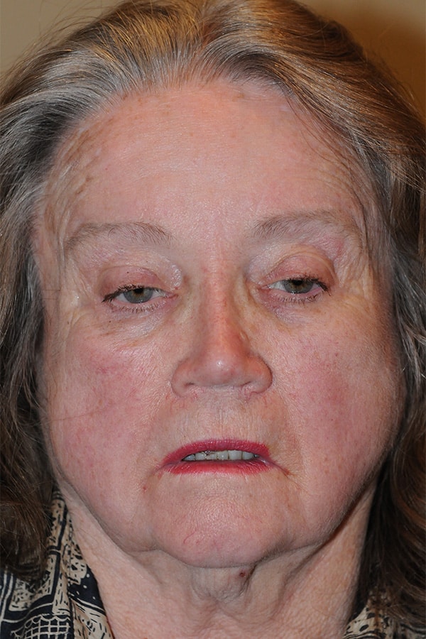 Before Image: Ptosis Repair - front