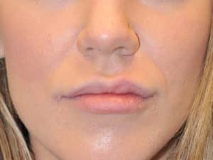 After Image: Lip Filler