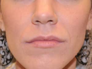 Before Image: Lip Filler