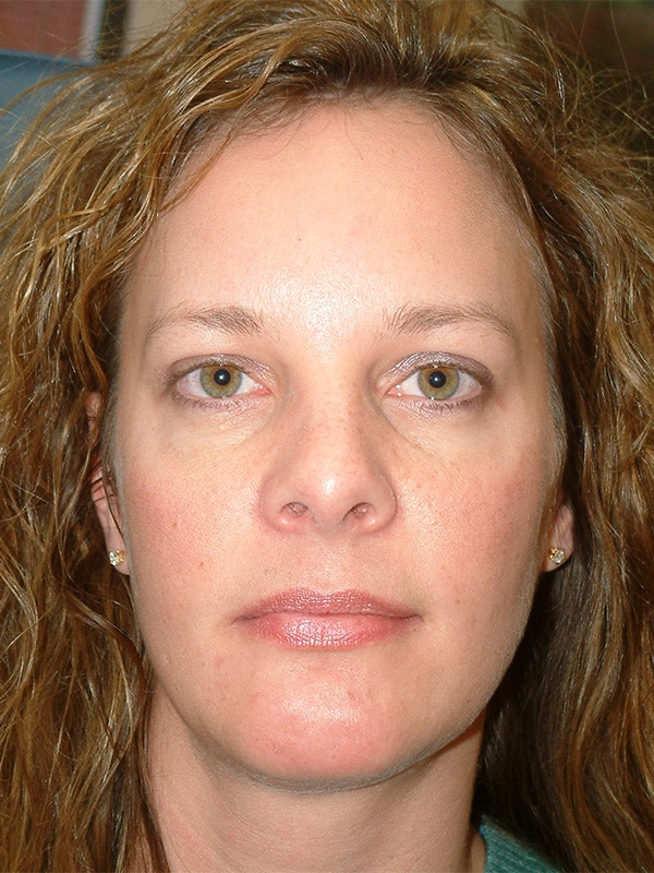 After Image: Upper & Lower Blepharoplasty - front