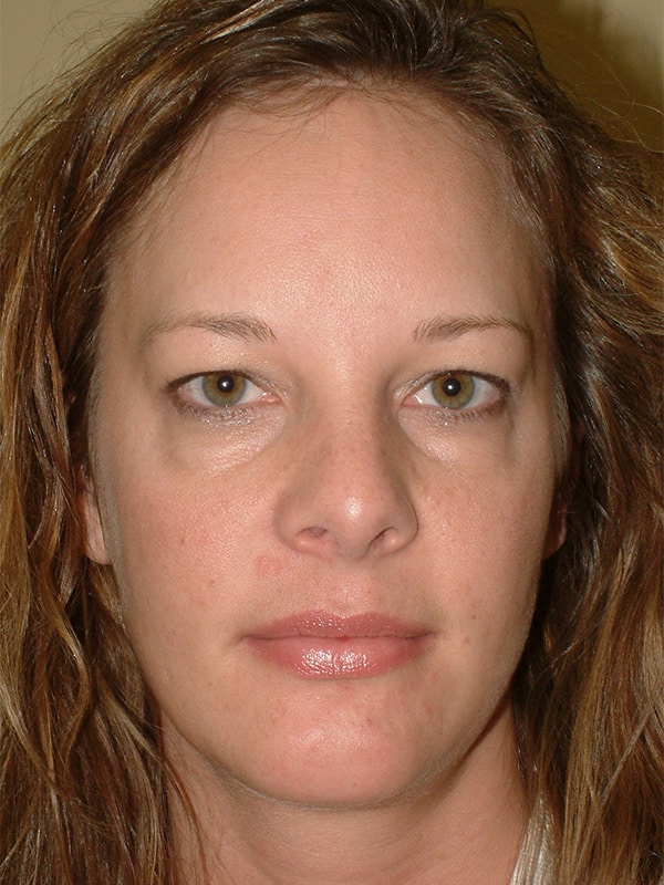 Before Image: Upper & Lower Blepharoplasty - front