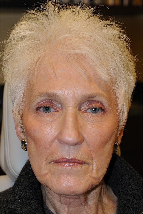 After Image: Ptosis Repair, Lower Blepharoplasty, CO2 Fractional Laser Resurfacing - front