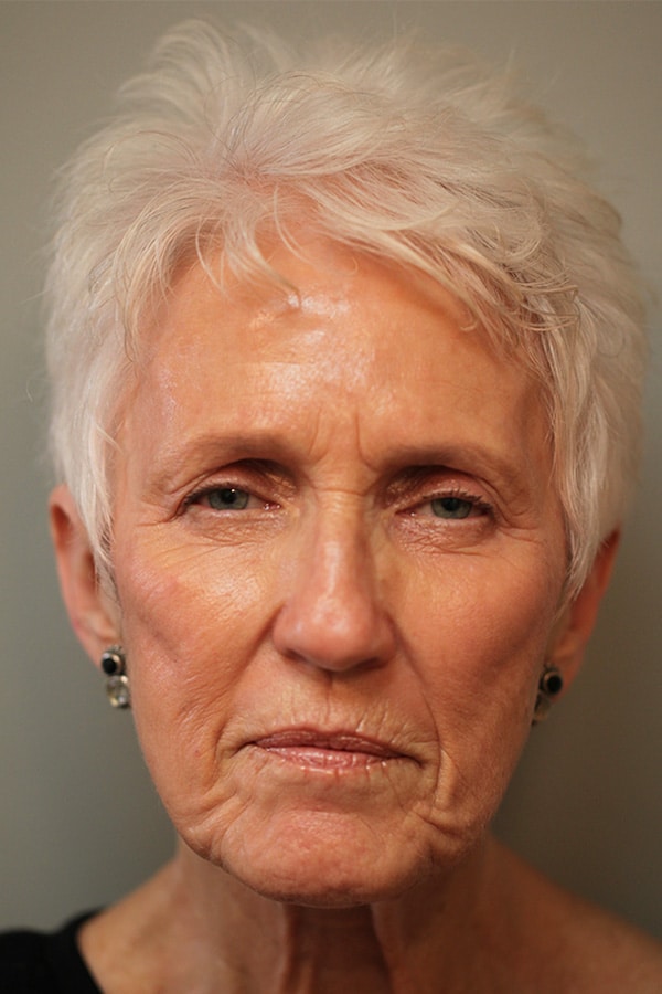 Before Image: Ptosis Repair, Lower Blepharoplasty, CO2 Fractional Laser Resurfacing - front