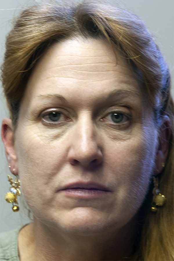 Before Image: Upper & Lower Blepharoplasty - front