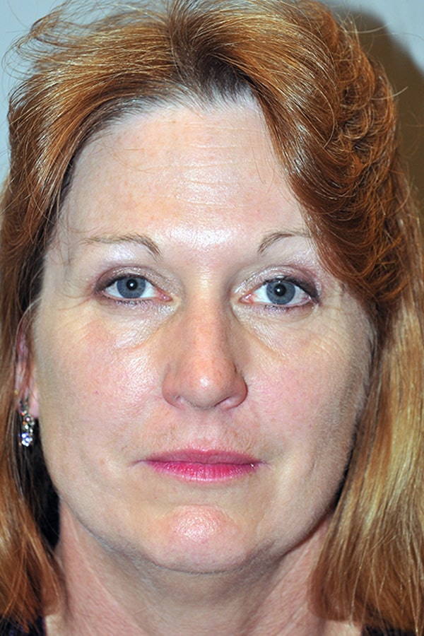 After Image: Upper & Lower Blepharoplasty - front