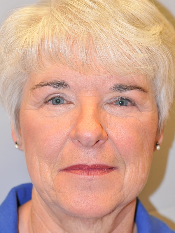 After Image: Ptosis Repair - front
