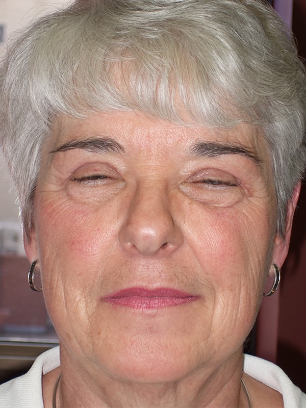 Before Image: Ptosis Repair - front