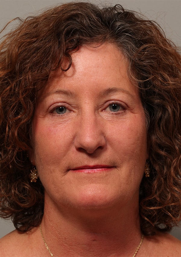After Image: Upper and Lower Blepharoplasty - front