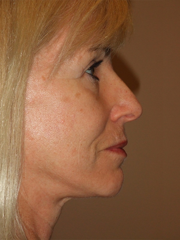 After Image: Facelift, Necklift and Lower Blepharoplasty - right-side