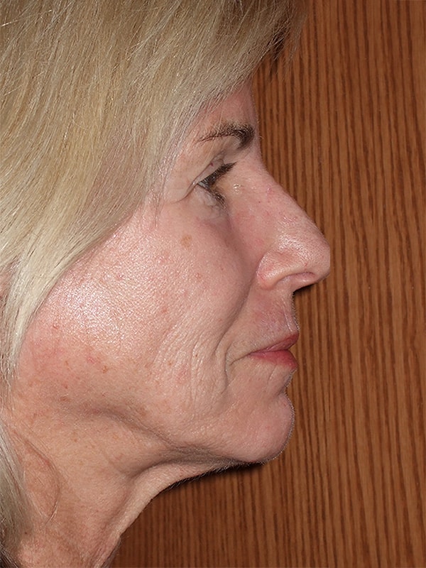 Before Image: Facelift, Necklift and Lower Blepharoplasty - right-side