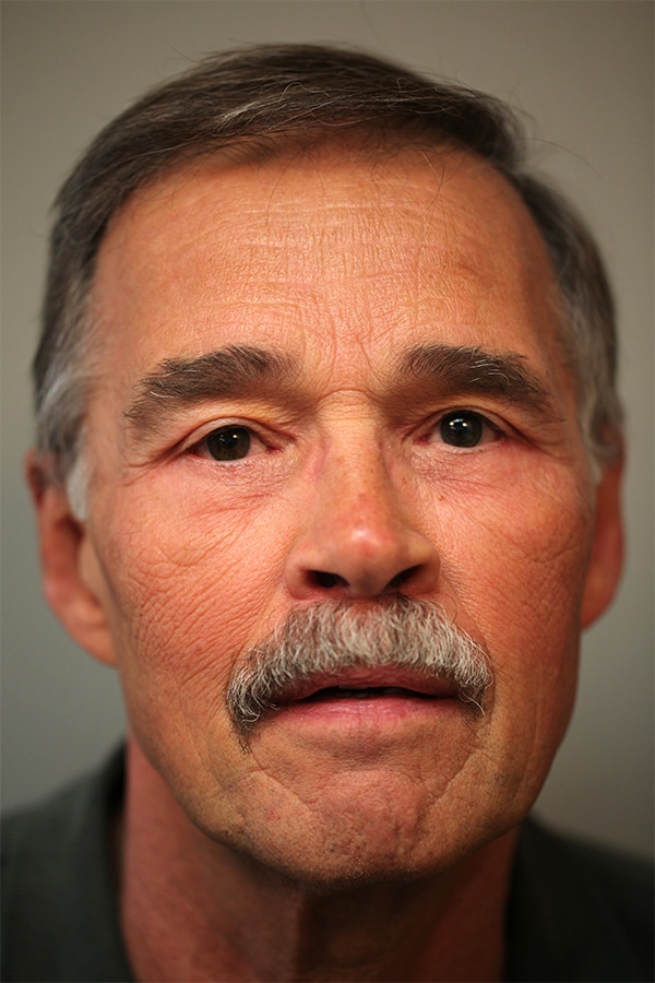 After Image: Upper & Lower Blepharoplasty - front