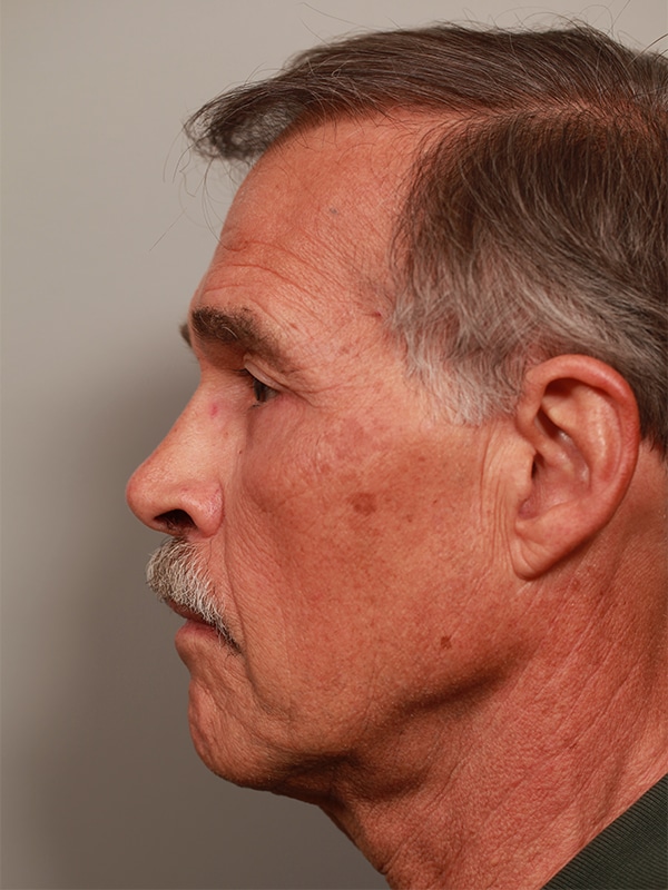 After Image: Upper & Lower Blepharoplasty - front