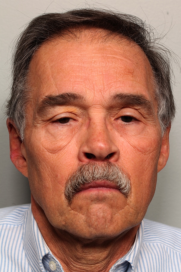Before Image: Upper & Lower Blepharoplasty - front