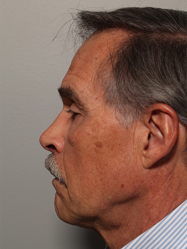 Before Image: Upper & Lower Blepharoplasty - front