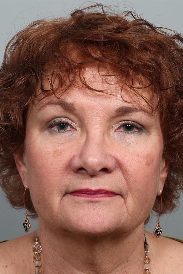 After Image: Upper & Lower Blepharoplasty - front