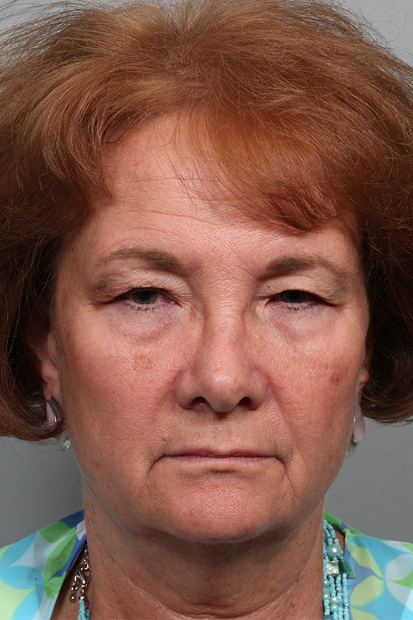 Before Image: Upper & Lower Blepharoplasty - front