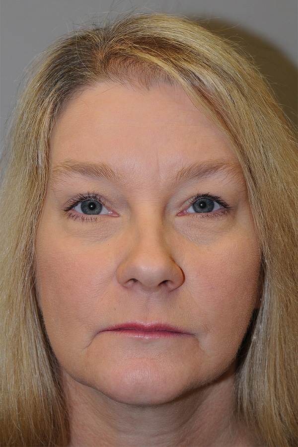 After Image: Ptosis Repair - front