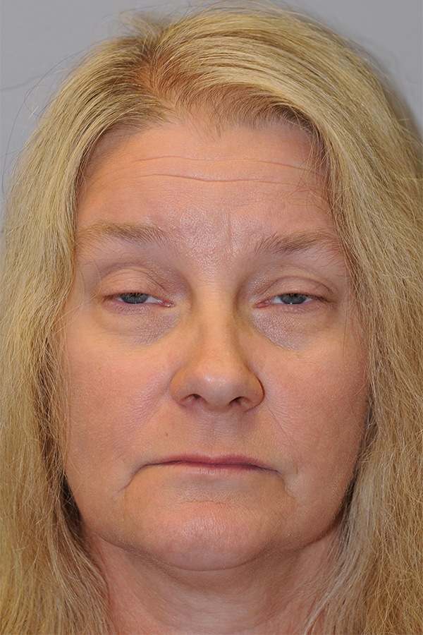Before Image: Ptosis Repair - front