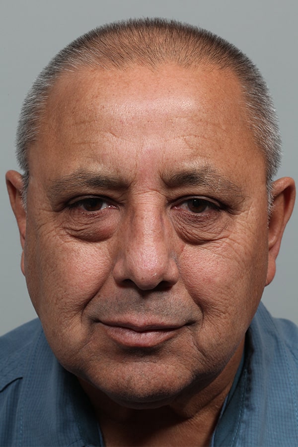 After Image: Upper Blepharoplasty - front