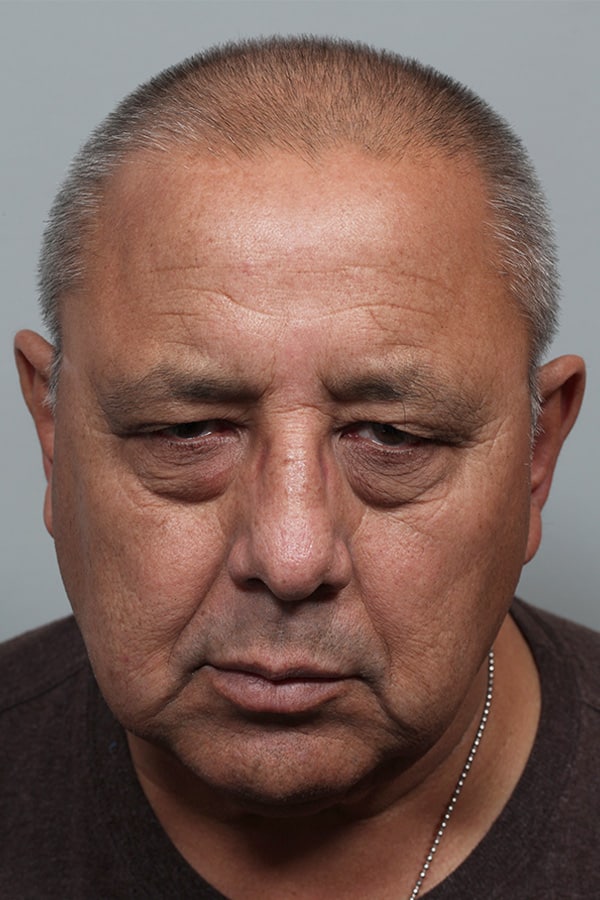 Before Image: Upper Blepharoplasty - front