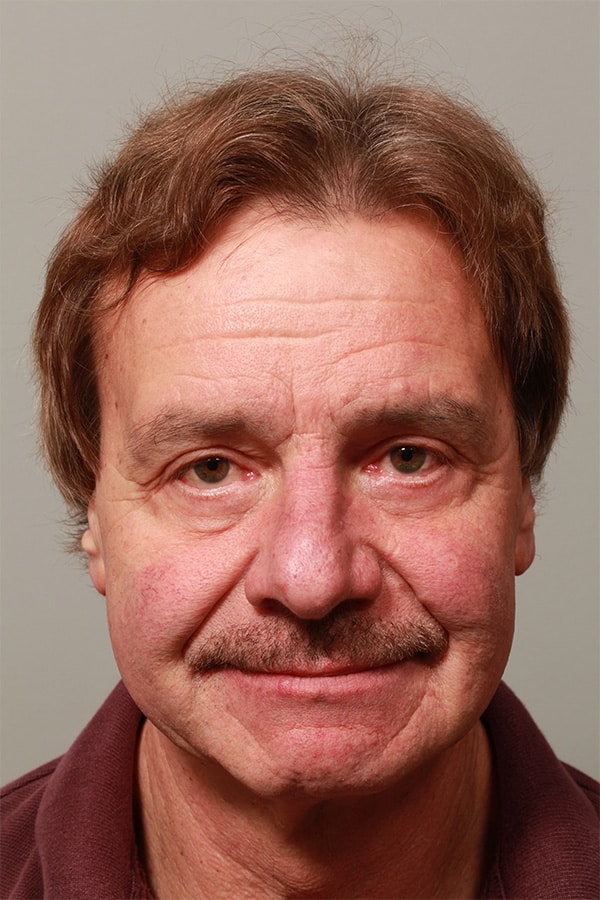 After Image: Upper and Lower Blepharoplasty - front