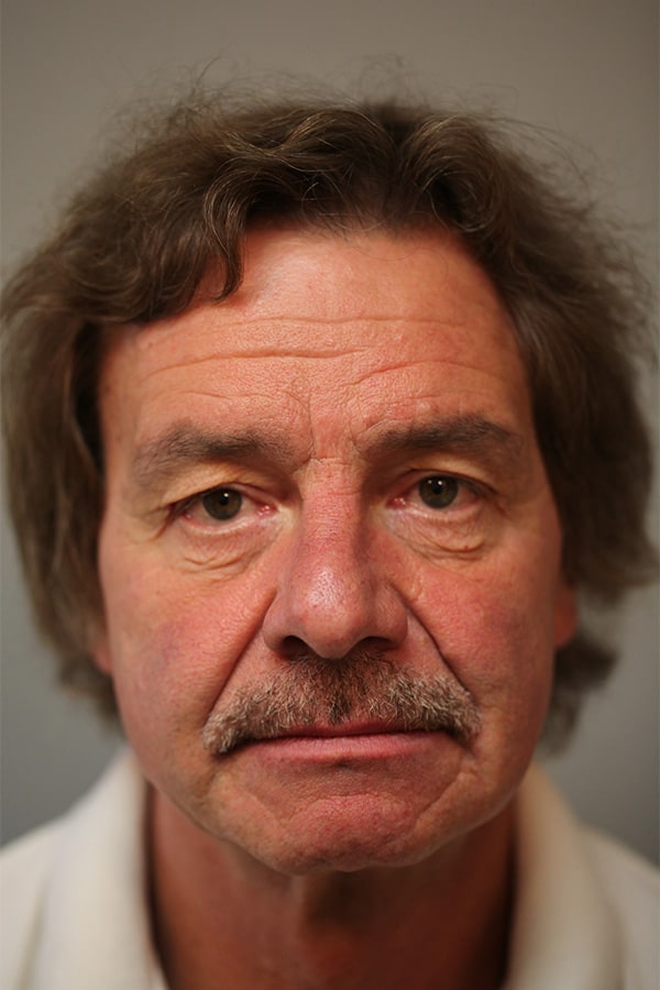 Before Image: Upper and Lower Blepharoplasty - front
