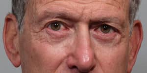 Lower Blepharoplasty