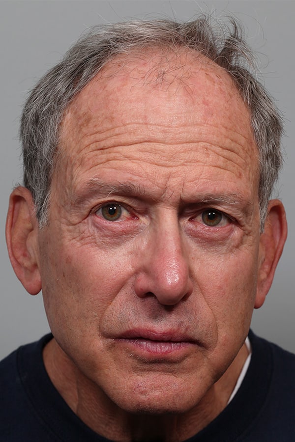 After Image: Lower Blepharoplasty - front