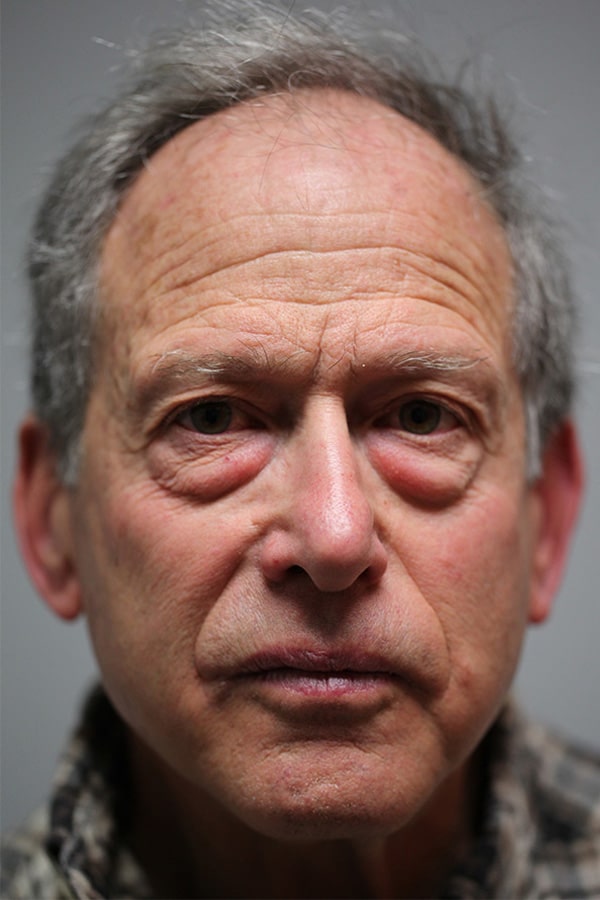 Before Image: Lower Blepharoplasty - front
