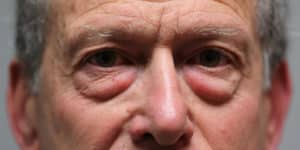 Lower Blepharoplasty