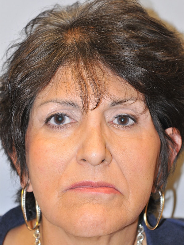 After Image: Left Ptosis Repair - front