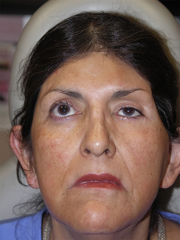 Before Image: Left Ptosis Repair - front
